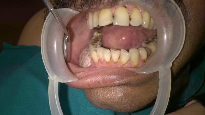 A 56-year old male patient visited the Department of Oral Medicine and Radiology, Yenepoya Dental College, Mangalore, with complaints of a growth in the right cheek region since 4 weeks.