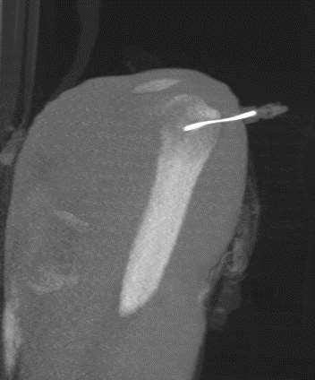 Left humeral needle (45 mm