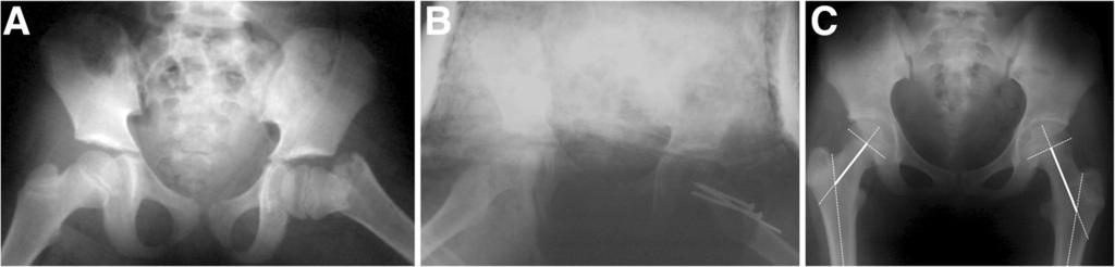 Kuo et al. Journal of Orthopaedic Surgery and Research (2016) 11:50 Page 4 of 5 Fig. 3 Representative radiographs of the femoral neck overgrowth after a type II femoral neck fracture.