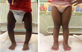 Fig 6 Child with bilateral flexible flat feet and fallen medial arches, hyperpronation of foot (left) and valgus heels (middle, red line showing outward tilting of both heels) with too many toes sign.