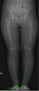 Fig 8 Long leg radiograph of a child with rickets.