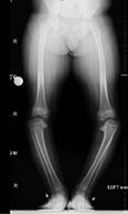 of the right leg Fig 9 Long leg radiographs of child with bilateral Blount s disease of proximal tibia.