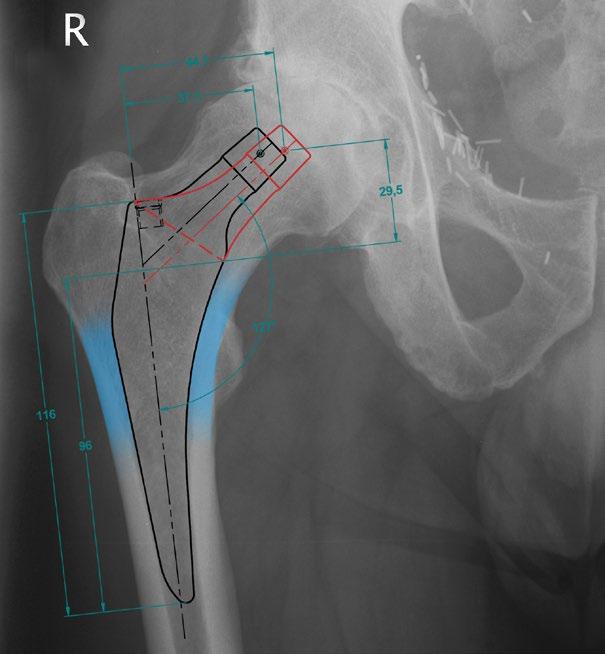 This can allow time for stress relaxation within the femur, if this occurs the final rasp may become less stable after acetabular preparation.