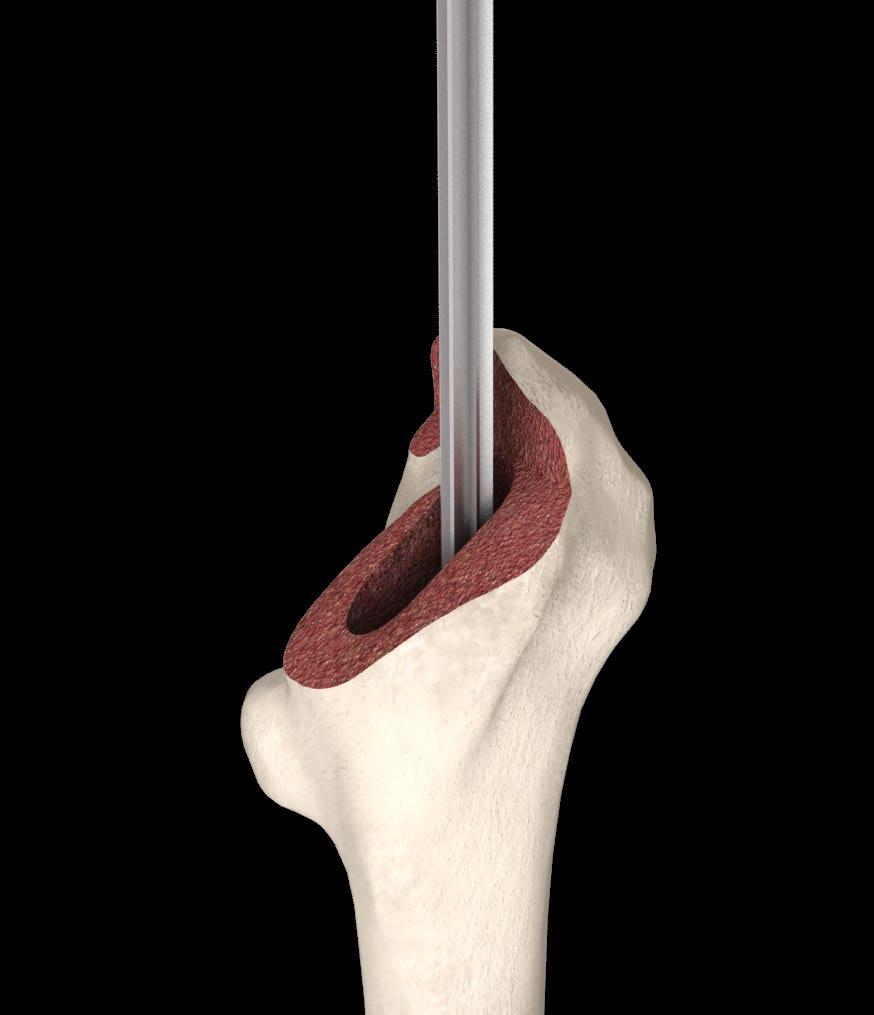 4. Intra-medullary (IM) reamer The T-handled reamer is used to define the neutral axis of the femoral canal. It is important to create an open pathway to the appropriate depth.