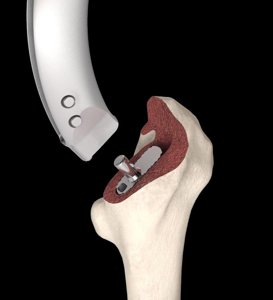 If excessive resistance is felt at this stage this is normally due to slight varus instrument alignment which can be corrected by lateralising the proximal part of the IM reamer further into the