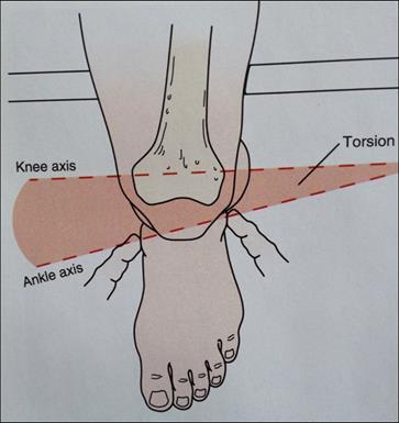 rotated Malleolar Position Indirectly represents Tibial Torsion The Foot examination &