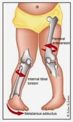 In-Toe gait- a symptom Trips and Falls a lot 3 main causes: Metatarsus Adductus