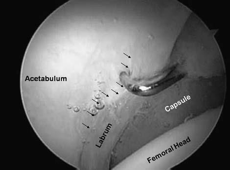 Labrum Function Extension of