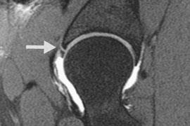 Labral tears in 86% College