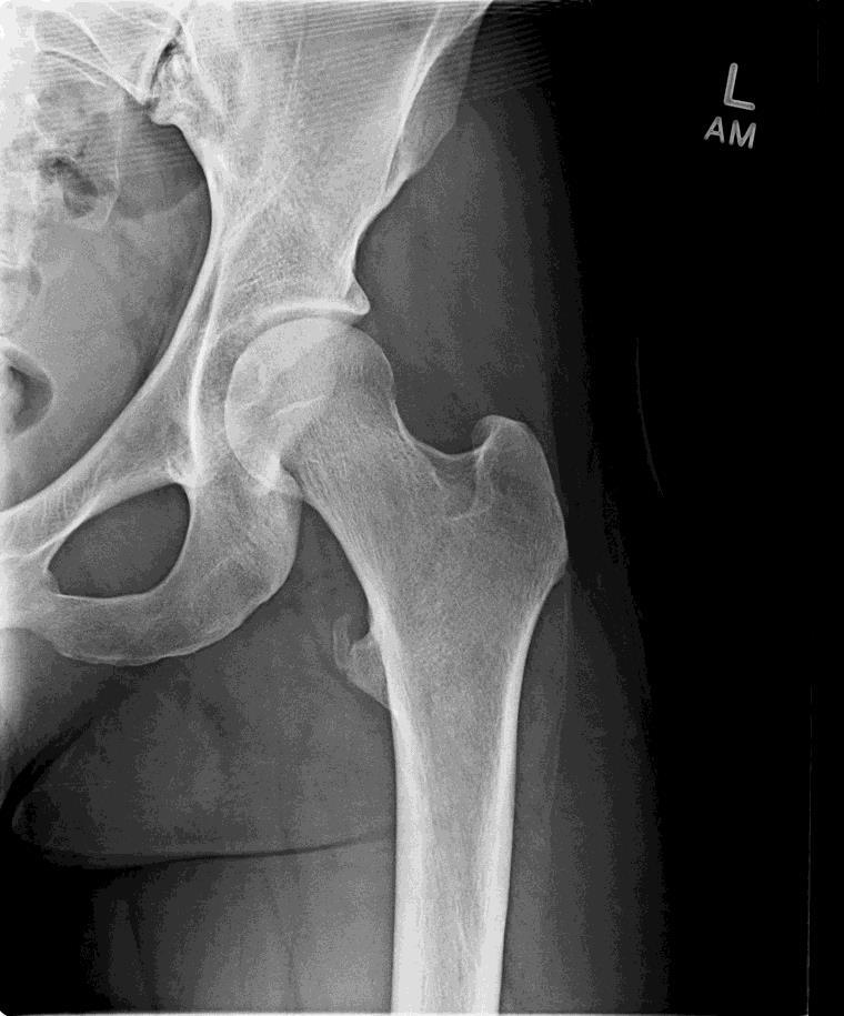 osteotomy OA w superomed migration Prox
