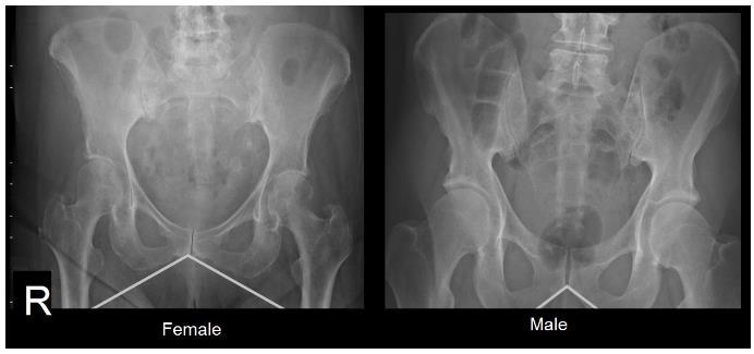 Pelvic Structural Differences Female Greater iliac flare Wider pubic angle