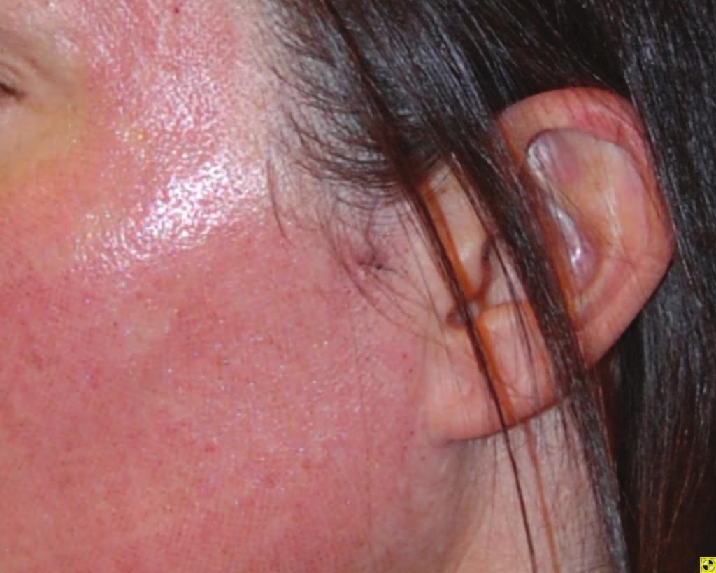 Wound healing of ablative