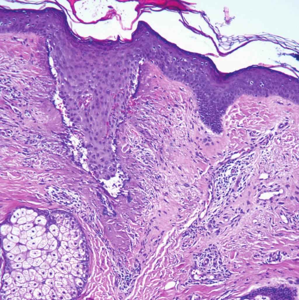 fractional microscopic lesions: biopsies taken (a)