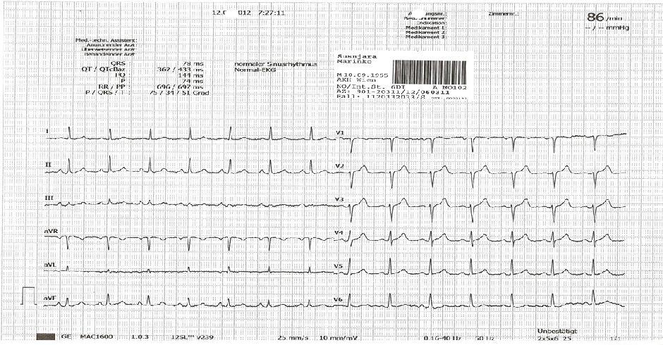 analize, ponovni EKG ( slika 4) i ultrasonografija srca. Laboratorijske vrednosti su bile: Troponin 0.