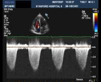 pulmonary hypertension Clinical Presentation of Idiopathic Pulmonary Arterial Hypertension Echocardiography in