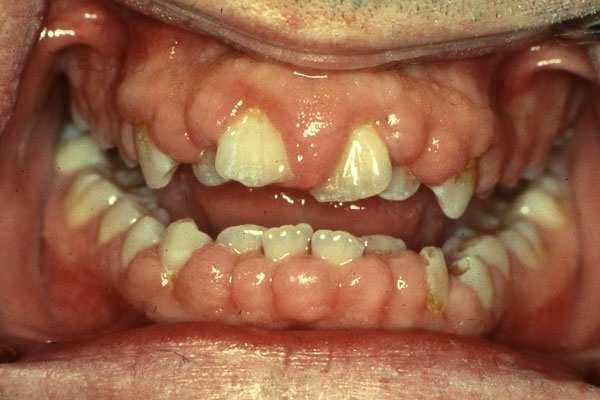 article72 Tumoral syndrome: infiltration by leukemic cells - Adenopathies - Hepato-Splenomegaly -Visceral localisations: gums, bones, skin, testicles,.
