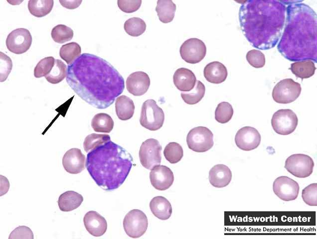 Classification Acute Myeloid Leukemia (AML) FAB: morphology, degree of differenciation of blasts (LAM 0 to LAM 7 ) OMS: Clinical, morphological &