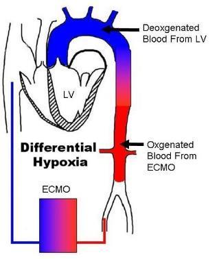 WHY NOT VENO ARTERIAL ECMO? Differential hypoxia!