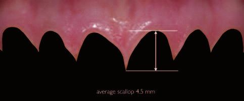 5). At a time when patients perceive fuller and brighter smiles as most aesthetic, 4mm of maxillary central incisor display while the lips are at rest may be ideal.
