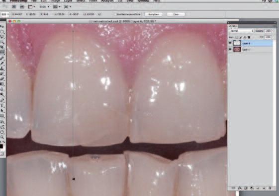 1 The length of teeth also affects aesthetics. Maxillary central incisors average between 10mm and 11mm in length.