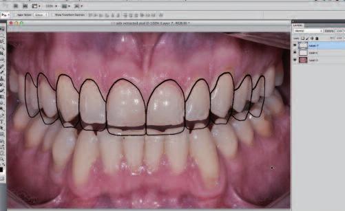 27 28 29 30 Figure 27: Open the image of the chosen tooth grid in Photoshop and drag the grid on to the image of teeth to be smile designed.