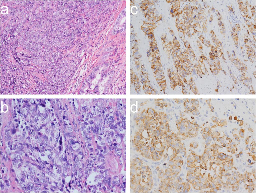 Liu et al. World Journal of Surgical Oncology (2015) 13:114 Page 4 of 5 Figure 2 Pathologically demonstrated mixed large-cell neuroendocrine carcinoma and adenocarcinoma of the gallbladder.
