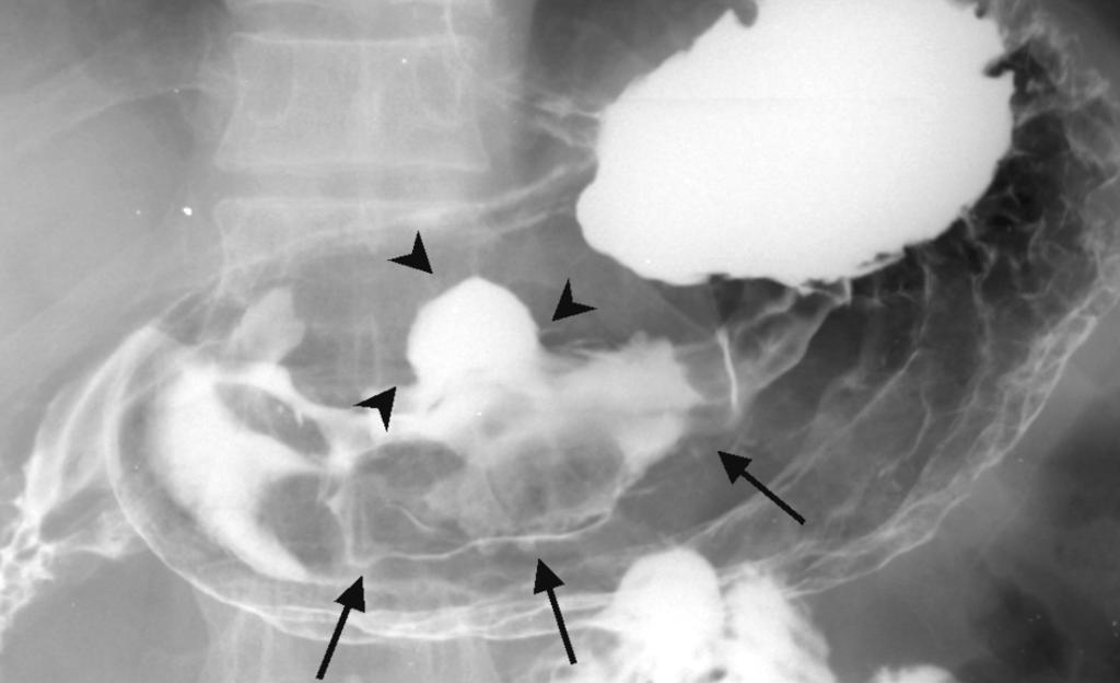 Hee Jung Kim, et al : Four Cases of Large Cell Neuroendocrine Carcinoma of the Stomach studies and CT imaging findings in four patients.