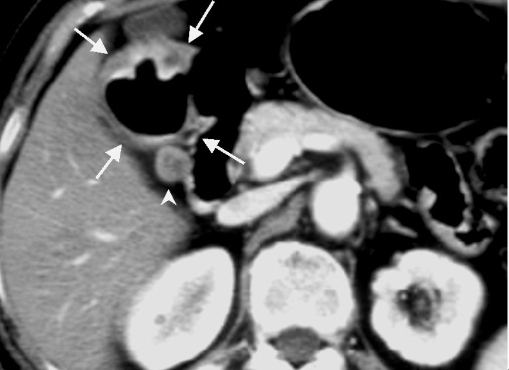 barium study that was performed in the patient demonstrated the presence of a 7-cm, well-marginated mass with a large ulceration in the lesser curvature of the antrum (Fig. 1).