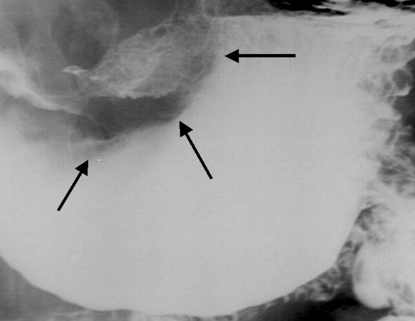 Fig. 4. 70-year-old male with a large cell neuroendocrine carcinoma of the stomach.. barium study shows a 5-cm, well-defined mass (arrows) in the lesser curvature side of the lower body to the antrum.