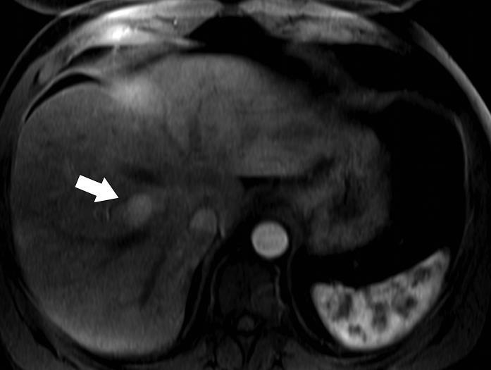 NET of the ileum (A) (B) Coronal contrast enhanced CT image of the pelvis demonstrates a 2cm