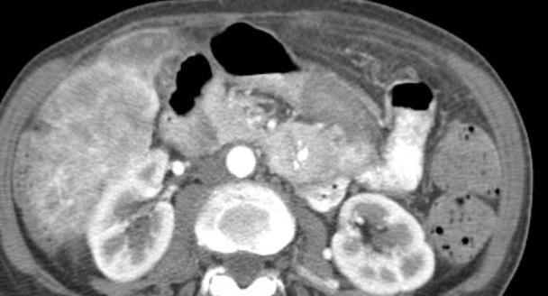 PNET Metastases CT Calcified mass in
