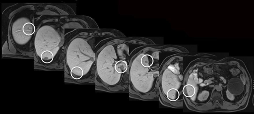 of which are identified on the portal venous phase CT Many more