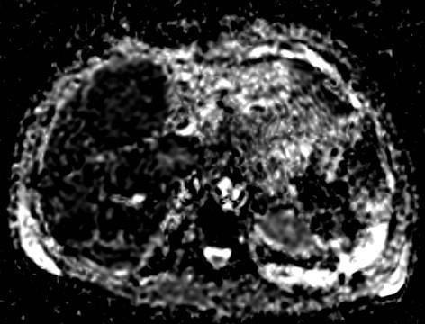 Metastatic ileal NET in 54 year old man (a, b) Axial contrast-enhanced, arterial phase MDCT