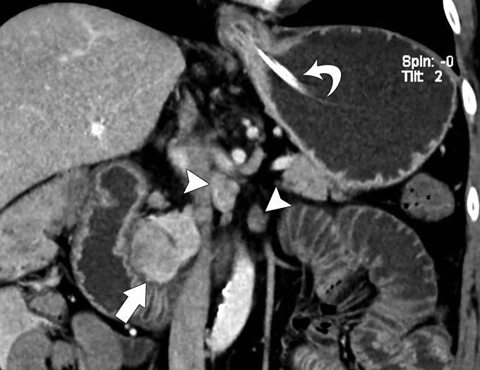 Functioning PNET - Gastrinoma A B (A) Coronal CE-MDCT images, 54 year old man with Zollinger-Ellison syndrome (ZES) and a large duodenal ulcer.
