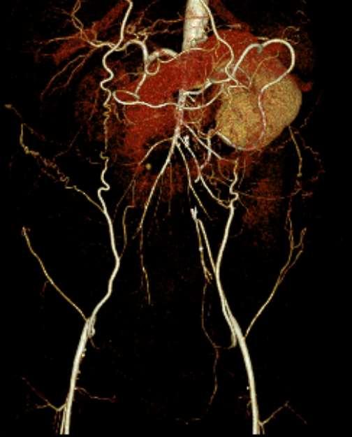 CT angiography showed an juxtarenal aortoiliac