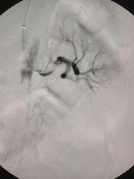Stenting a juxtarenal aortic occlusion without applying