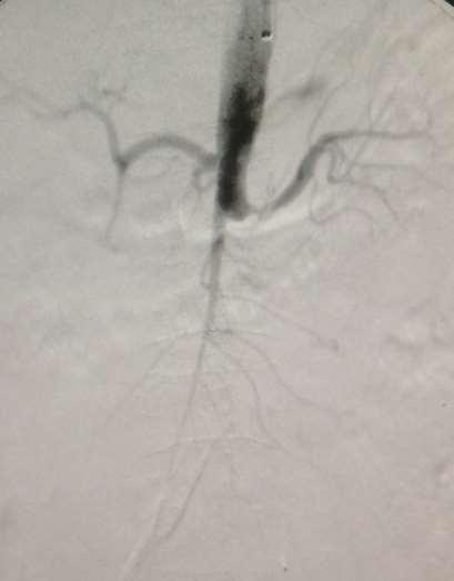 Left renal artery stenting