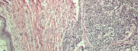 Small Cell Carcinoma (Neuroendocrine)