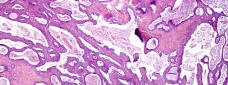 Uterine Serous Carcinoma with a glandular