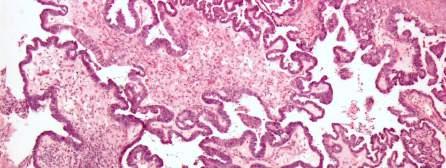 Serous LMP A serous neoplasm with increased epithelial proliferation, but without