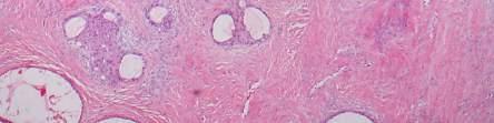 Tumor (LMP) Nests (adenofibroma pattern)
