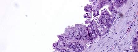 Mucinous LMP Carcinoma in-situ