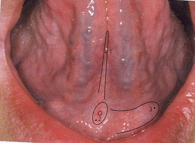 Under Surface Of The Tongue 1. Frenulum lingulae in the midline. It connects its under surface to the floor of the mouth. 2.