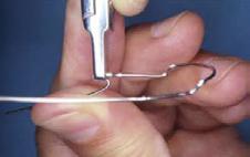Apply pressure to this distal bend using the tips of the lingual arch pliers.