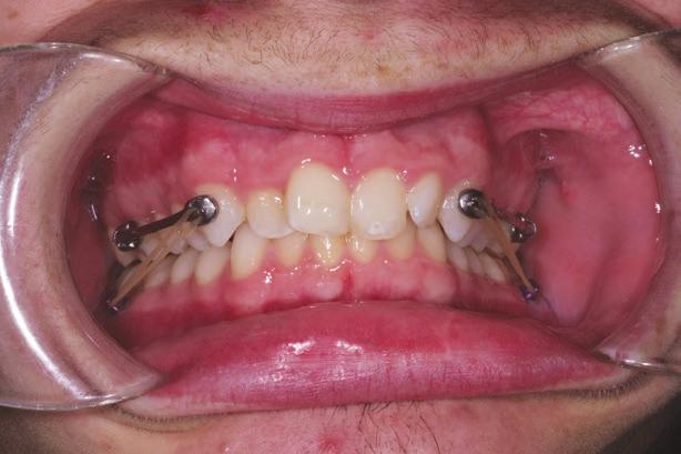 III. Fixed Appliances Bonded on the Mandibular Arch For patients who present with a severe curve of spee or mild crowding in the mandibular arch, it is advisable to bond brackets to the mandibular