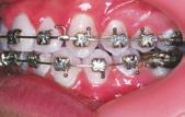 the  or aligner
