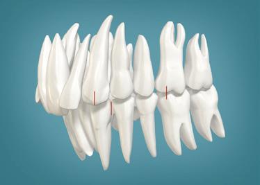 Class II Correction to a Class I Platform The Motion Appliance: Achieving Class I Prior to Tooth Positioning One philosophy for simplifying the nonextraction treatment of certain Class II patients is