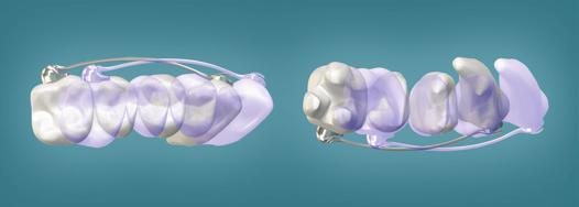 The Motion Appliance is designed to cultivate cuspid and buccal segment distalization that precludes such undesired side effects (Figure 2a-d) as well as offer technique simplicity and ease of