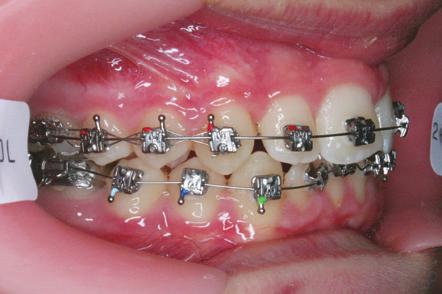 Once accomplished, and the clinician has removed the Motion Appliance and bonded the arches with the fixed appliance of choice to finish treatment, it is necessary to ligate the distalized teeth