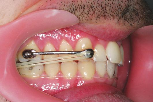 Anchorage Possible Sources of Anchorage To avoid protrusion of the mandibular incisors during activation of the Motion Appliance, clinicians must determine an adequate source of anchorage based on